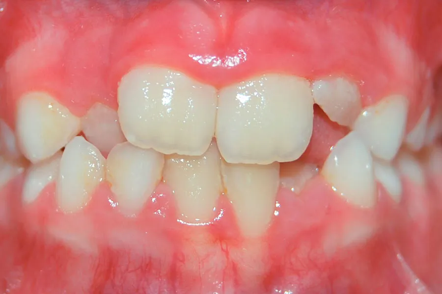 caso-clinico-frontal-antes-1