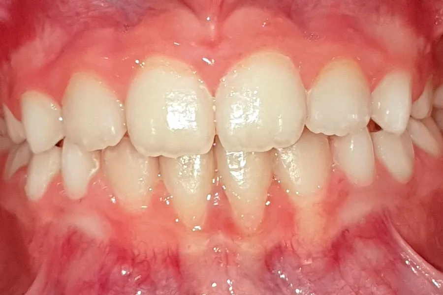 caso-clinico-frontal-despues-1