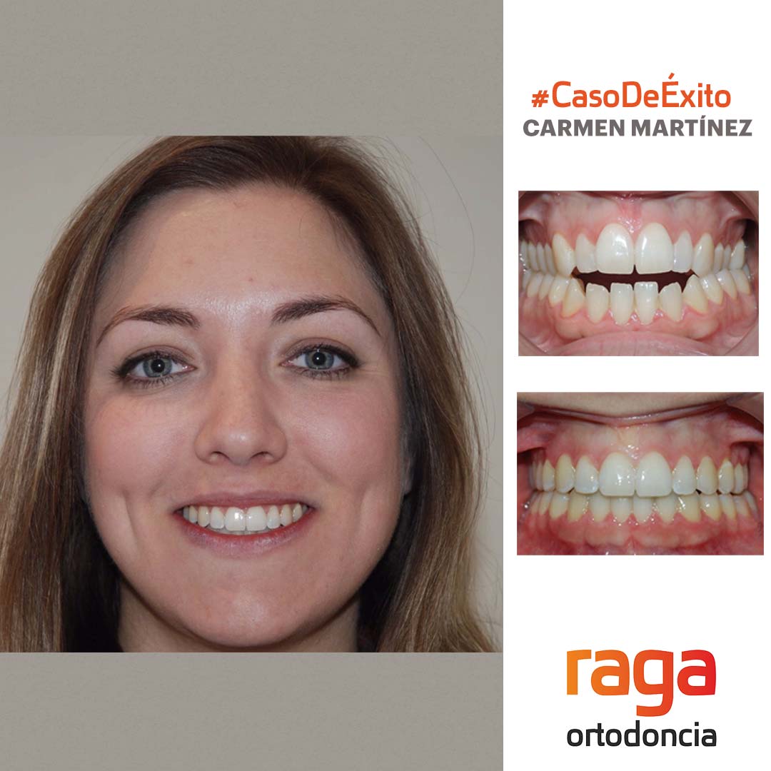 caso de exito invisalign 1