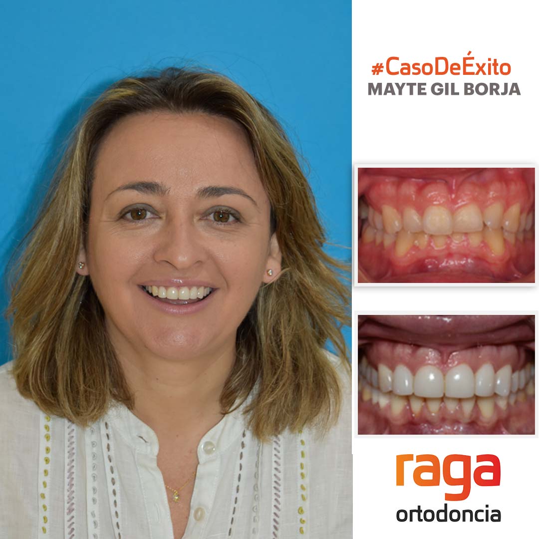 caso de exito invisalign 2