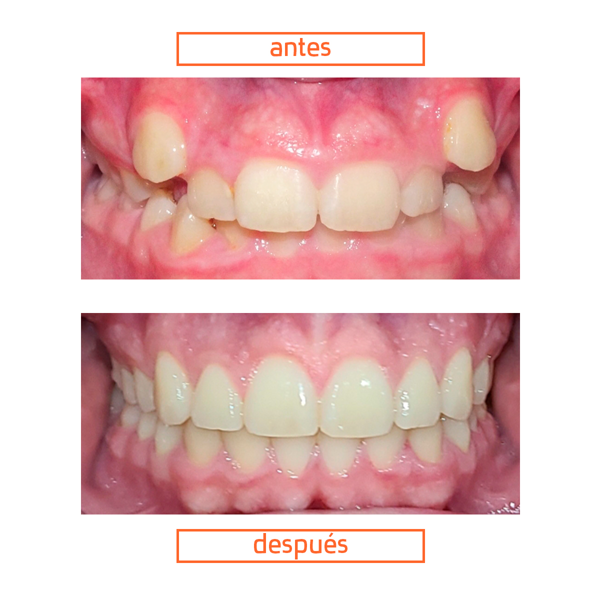 caso-ortodoncia-brackets-raga-valencia