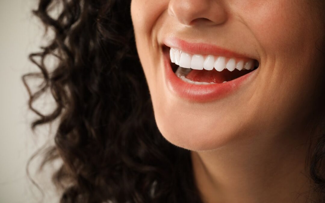 ¿Cuánto duran las carillas dentales?