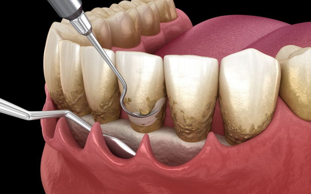 ¿Qué es el curetaje dental en periodoncia?