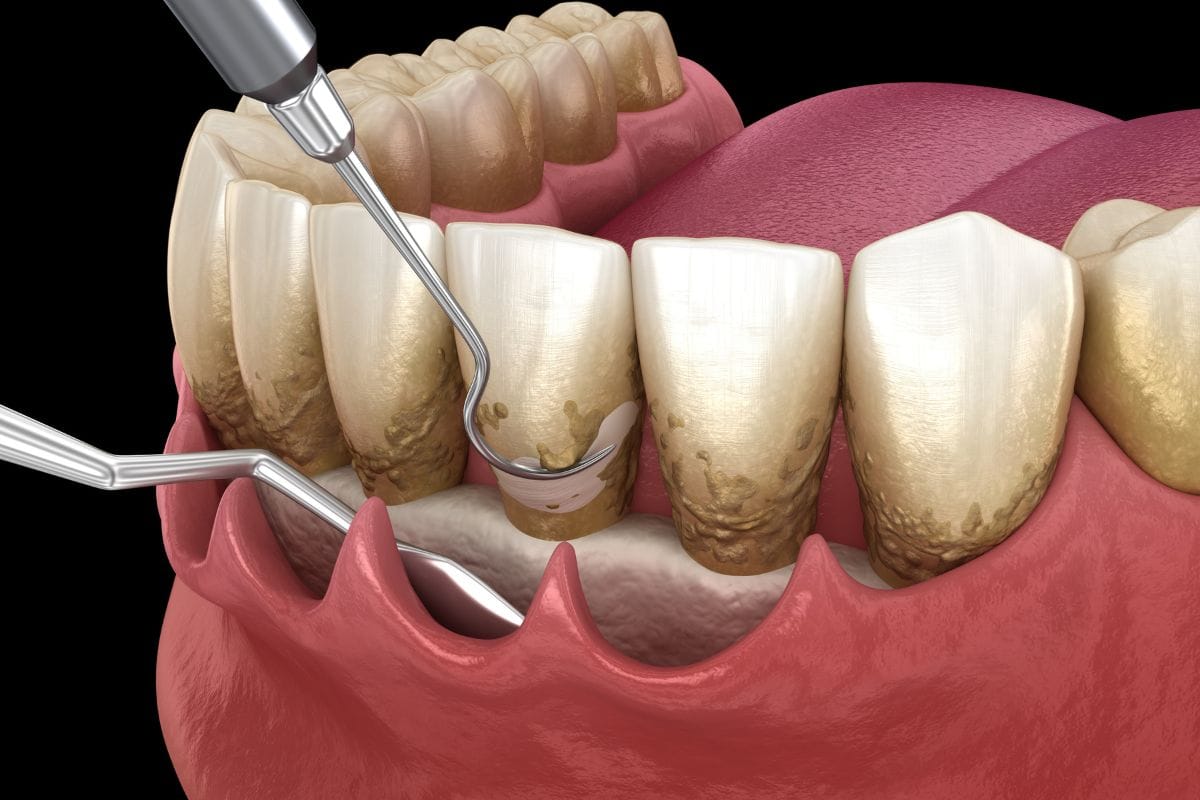 curetaje-dental