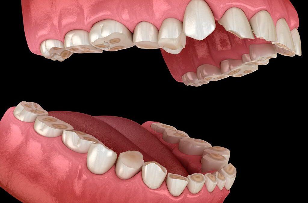 ¿Cómo puede ayudar la ortodoncia a evitar el desgaste dental?
