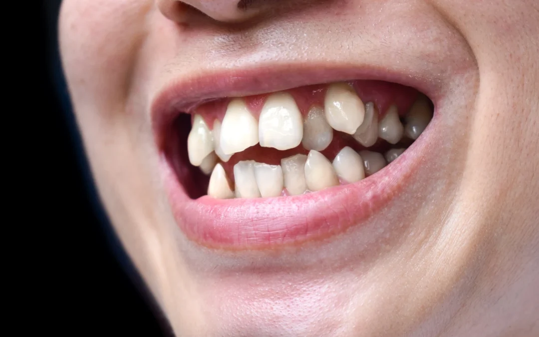 Dientes apiñados. ¿Cómo solucionarlo?