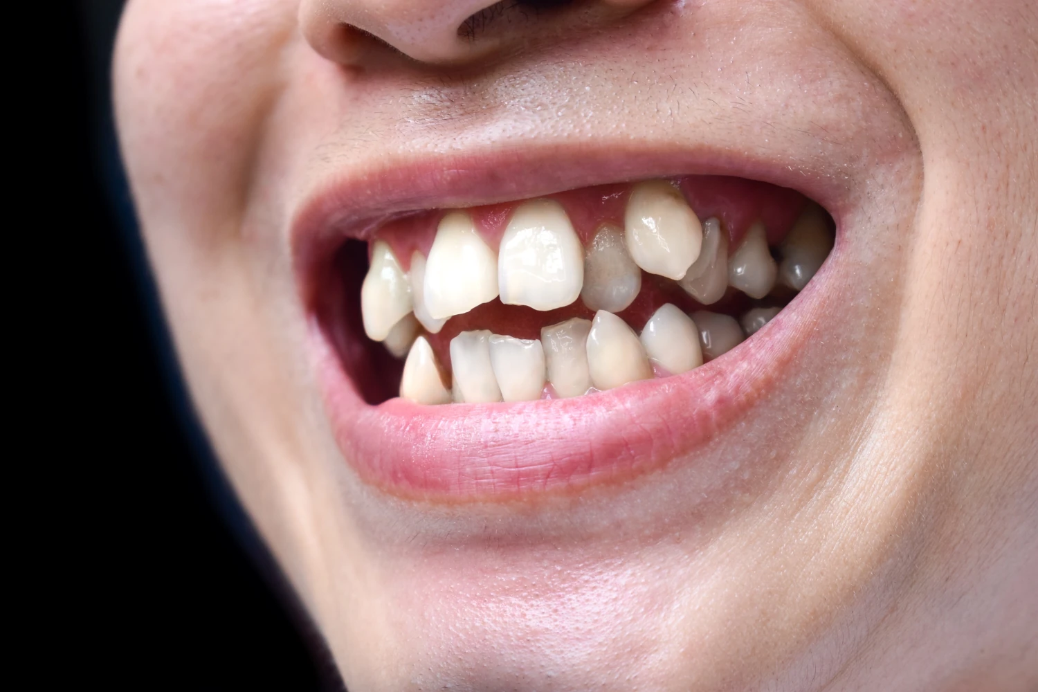 dientes-apinados