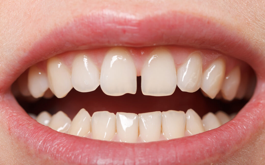 Diastema dental o dientes separados. ¿Cómo corregirlo?