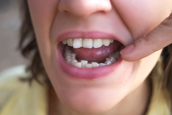 ¿Se pueden corregir los dientes torcidos en adultos?