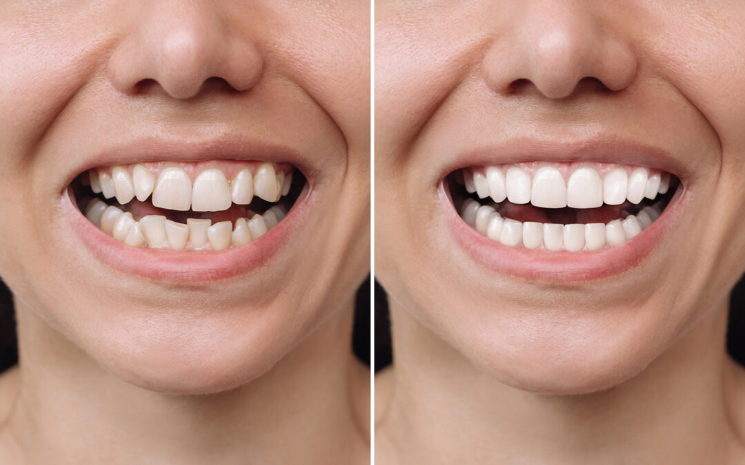 ¿Son recomendables las carillas en dientes torcidos?
