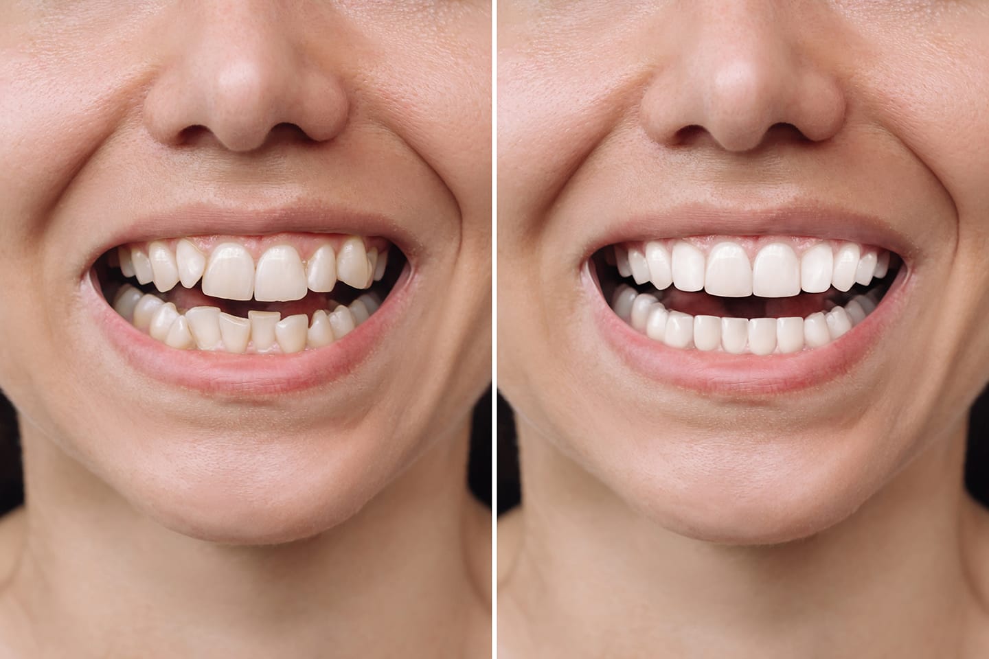dientes-torcidos-carillas-dentales