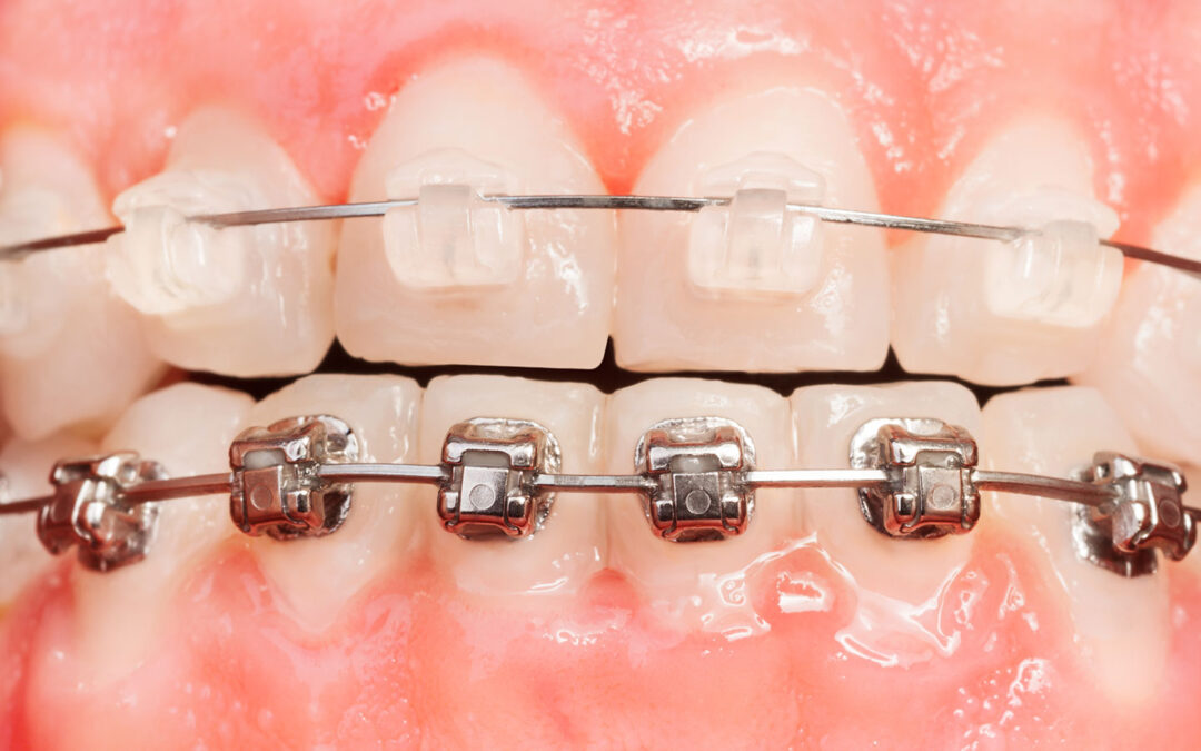 ¿Es lo mismo brackets estéticos que ortodoncia invisible?
