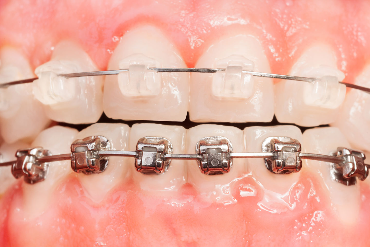 ¿Es lo mismo brackets estéticos que ortodoncia invisible?
