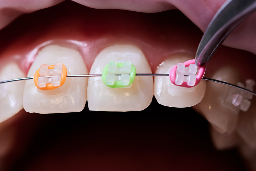 ¿Para qué sirven las gomas de los brackets?