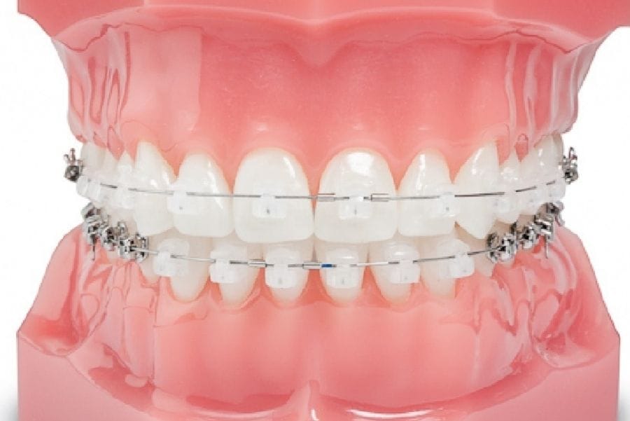 brackets autoligado