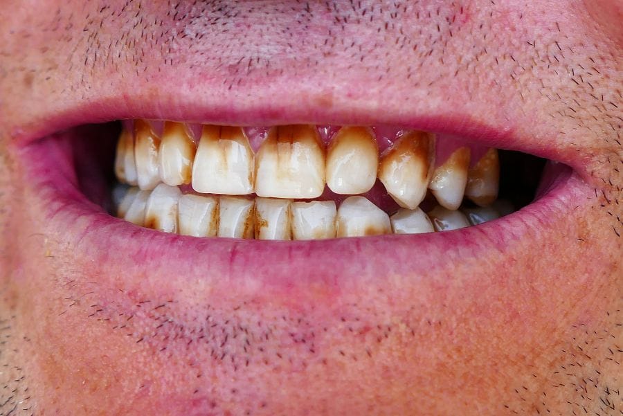 por qué se me tiñen los dientes