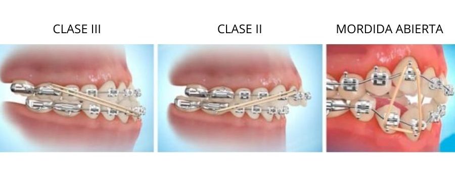 elásticos intermaxilares