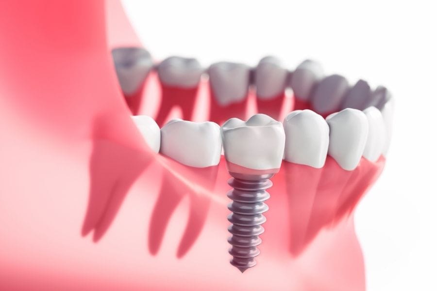 ortodoncia y falta de dientes