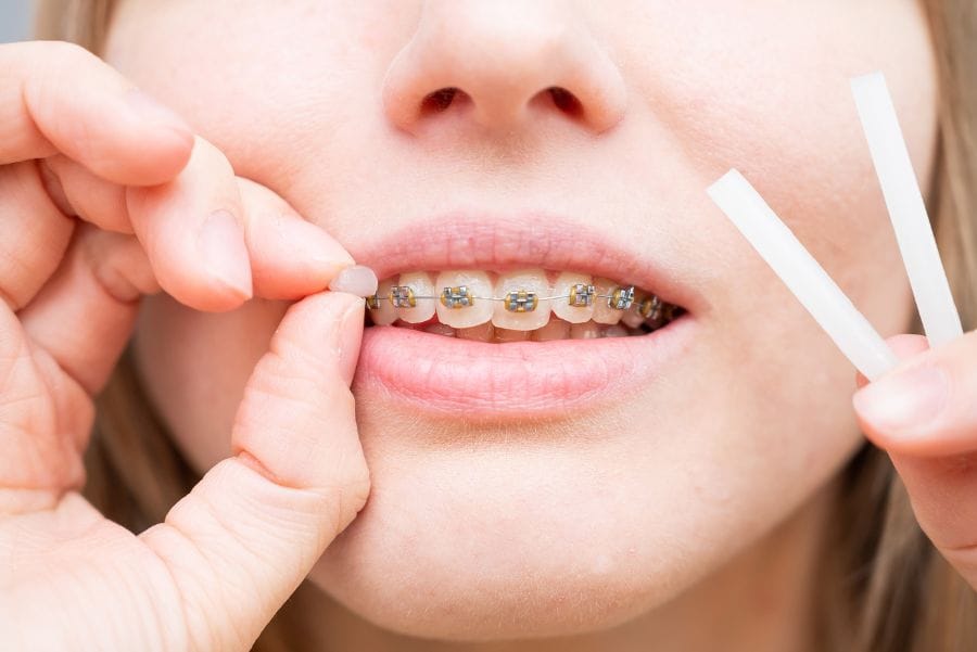 evitar que se despeguen los brackets