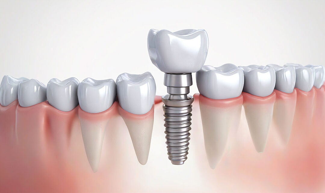 ¿Cómo puedo saber si se rechaza un implante dental?