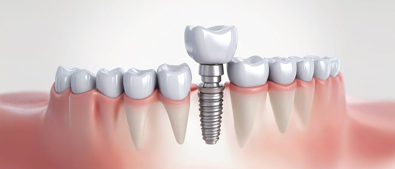 implantes-dentales
