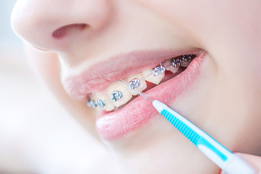 La importancia de la limpieza dental con brackets