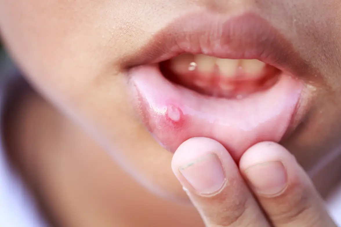 Labio inferior con una llaga por el uso de brackets
