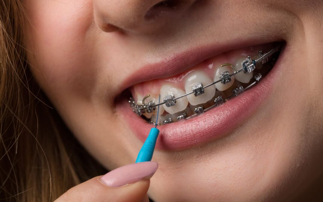 Llagas por brackets: cómo prevenirlas y tratarlas con ortodoncia bien planificada
