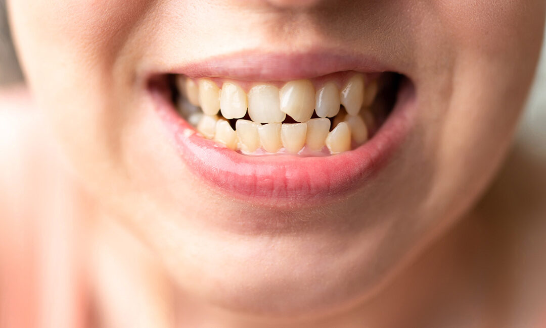 ¿Qué es la maloclusión dental y cómo corregirla?