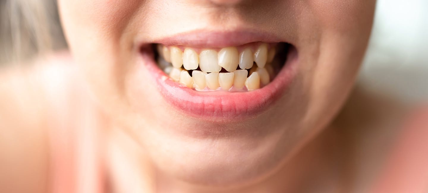 ¿Qué es la maloclusión dental y cómo corregirla?