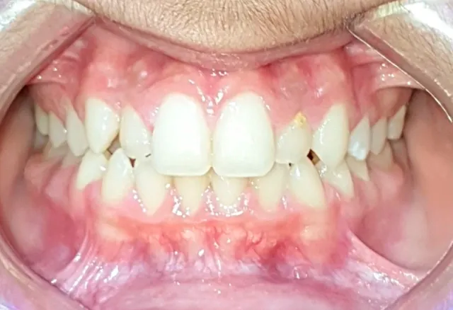 mateu-inicio-frontal-fase2