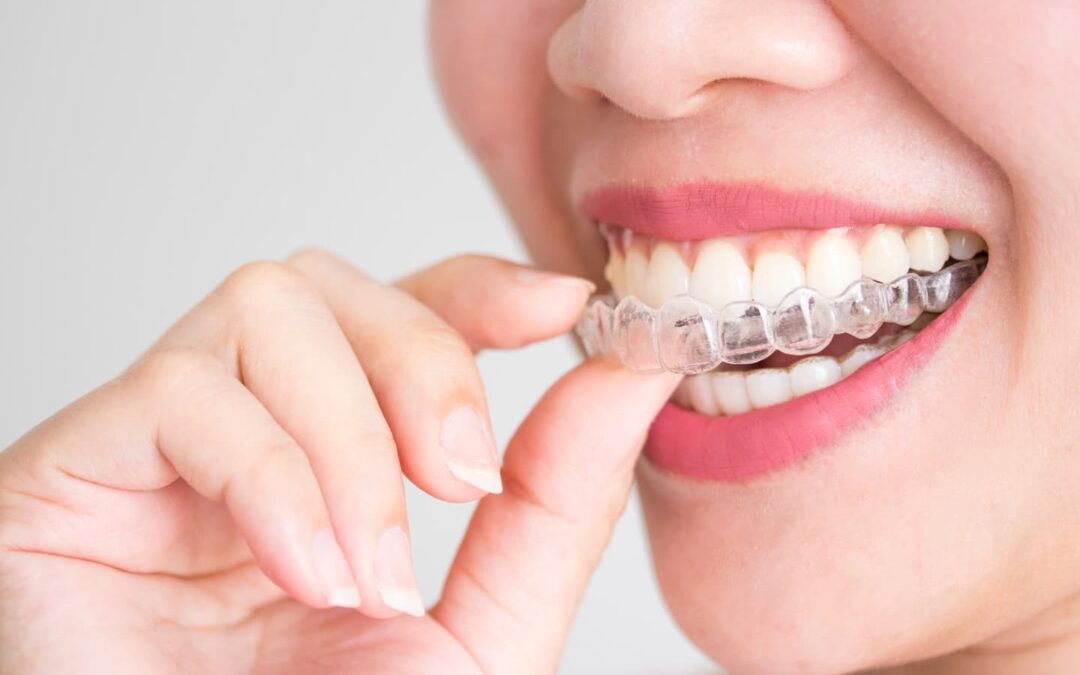 ¿Cómo mejorar la apariencia de los dientes salidos?