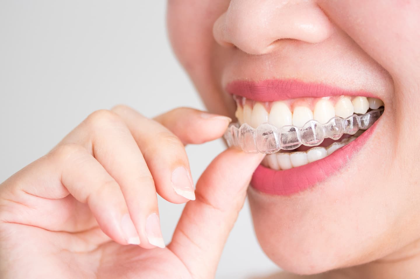 mejorar dientes salidos con ortodoncia invisible