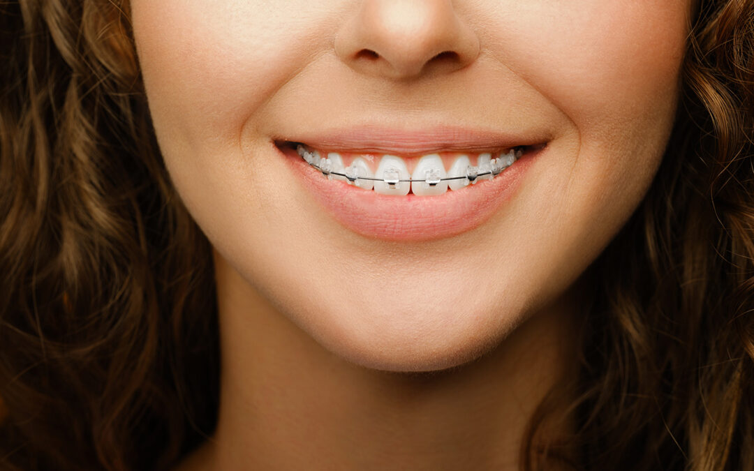 ¿Cómo saber si te tienen que poner brackets?