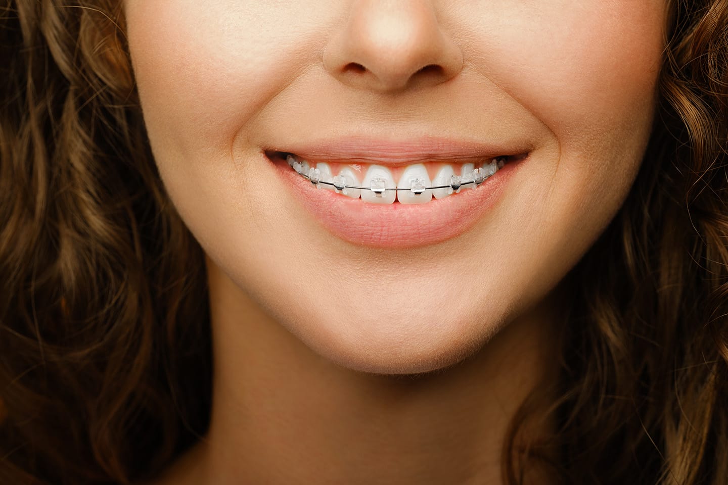 ortodoncia-brackets-esteticos
