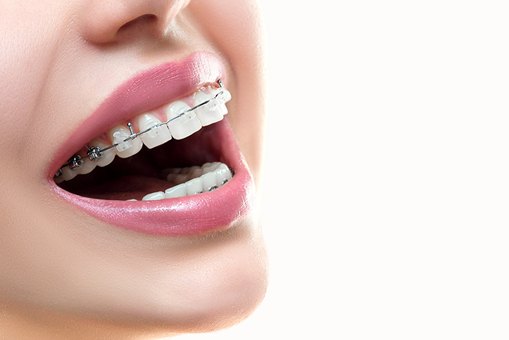 ¿Qué opciones de ortodoncia estética hay?