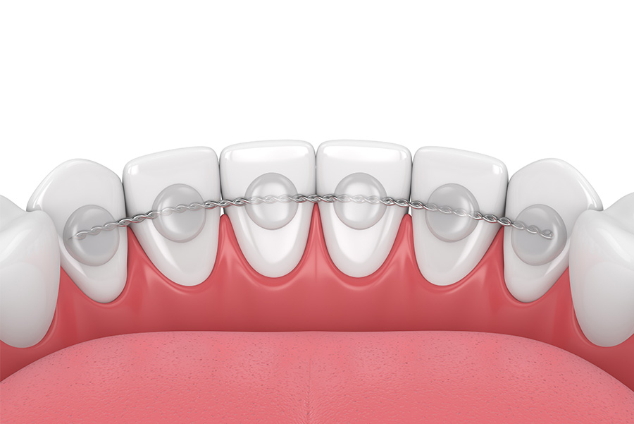 ¿Cuánto tiempo debo usar retenedores dentales?