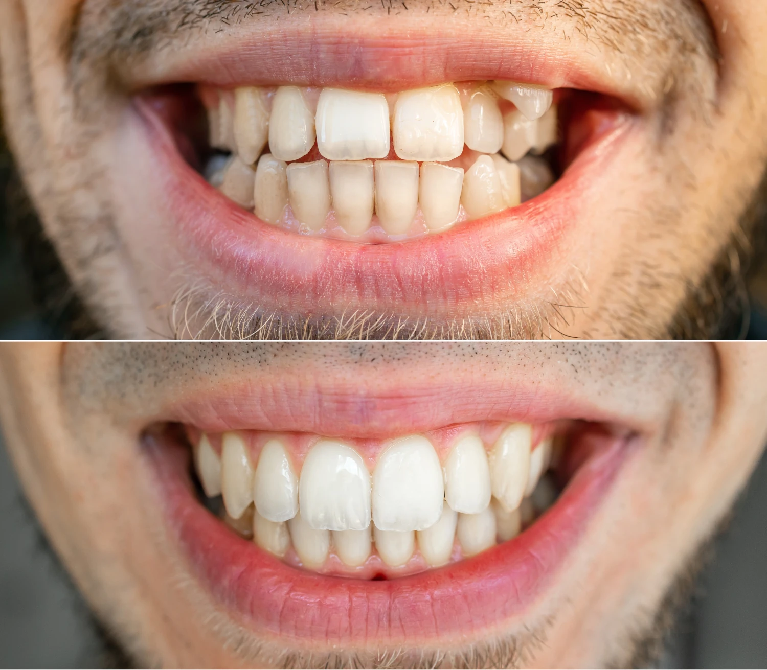 solucion-dientes-apinados