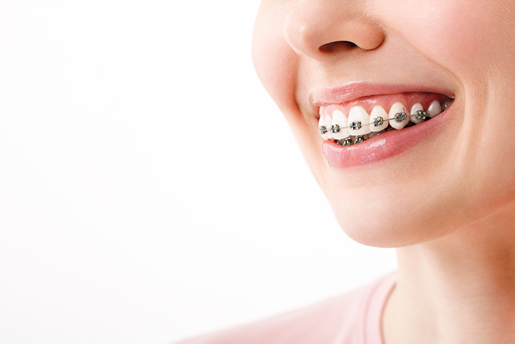 10 alimentos que no debes comer si llevas brackets
